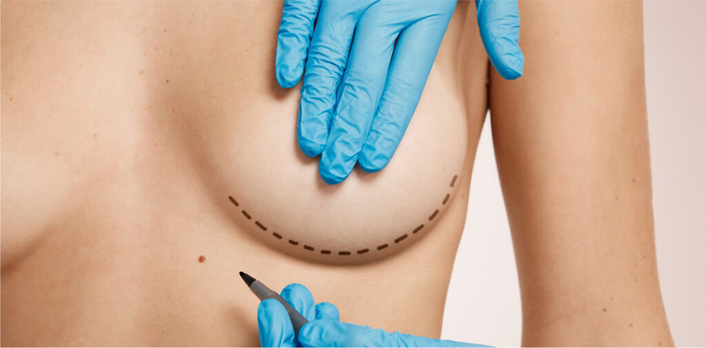 Маммопластика – гармонійна форма та ідеальний об’єм грудей