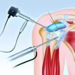 Когда назначается артроскопия плечевого сустава?